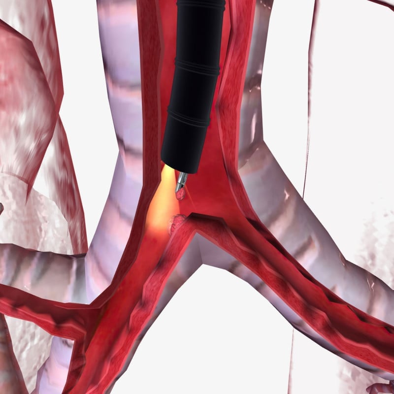 HD-500 Video Bronchoscope Medvana UK